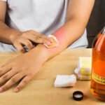 removing mole with apple cider vinegar
