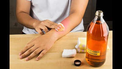removing mole with apple cider vinegar
