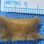fish bone stuck in indian mans airway removed