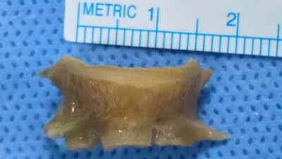 fish bone stuck in indian mans airway removed